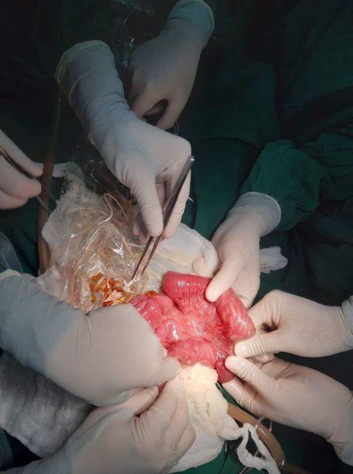 Bác sĩ phát hiện nửa kg giun trong bụng cháu bé 3 tuổi