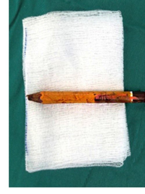 Bé trai ở Sài Gòn cấp cứu vì bị cây bút chì đâm vào mông sâu đến 8cm