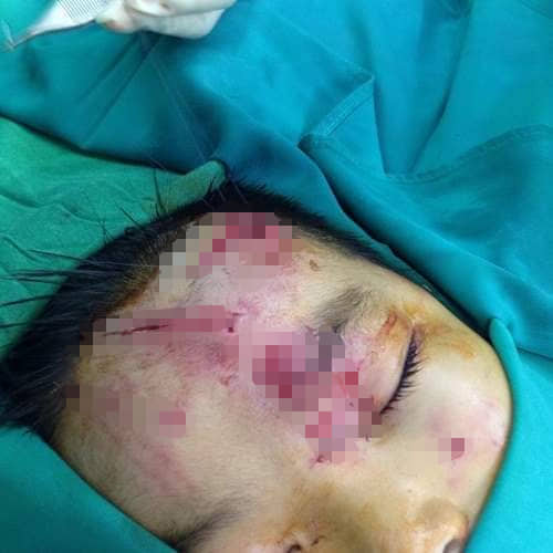Nghệ An: Bé trai 7 tuổi bị chó cắn biến dạng mặt