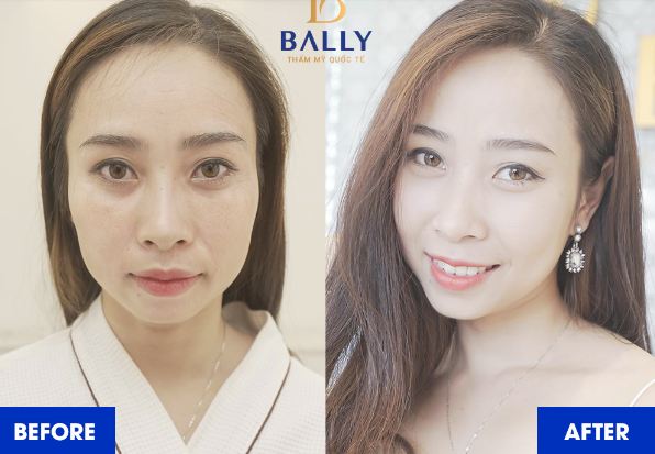 Hiệu quả thần kỳ của công nghệ trẻ hóa da Ultherapy tại thẩm mỹ Bally