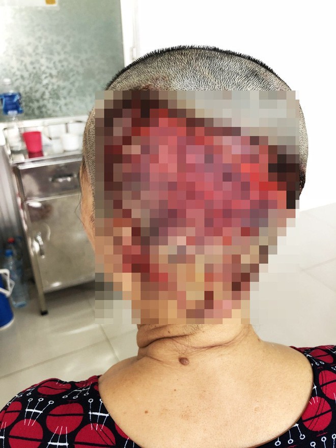 Gia Lai: Người phụ nữ bị hoại tử vùng đầu vĩnh viễn vì uốn tóc