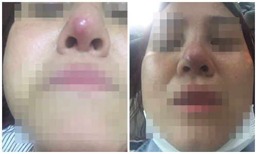 TMV Việt Hàn: Phẫu thuật nâng mũi chui, lừa đảo khách hàng