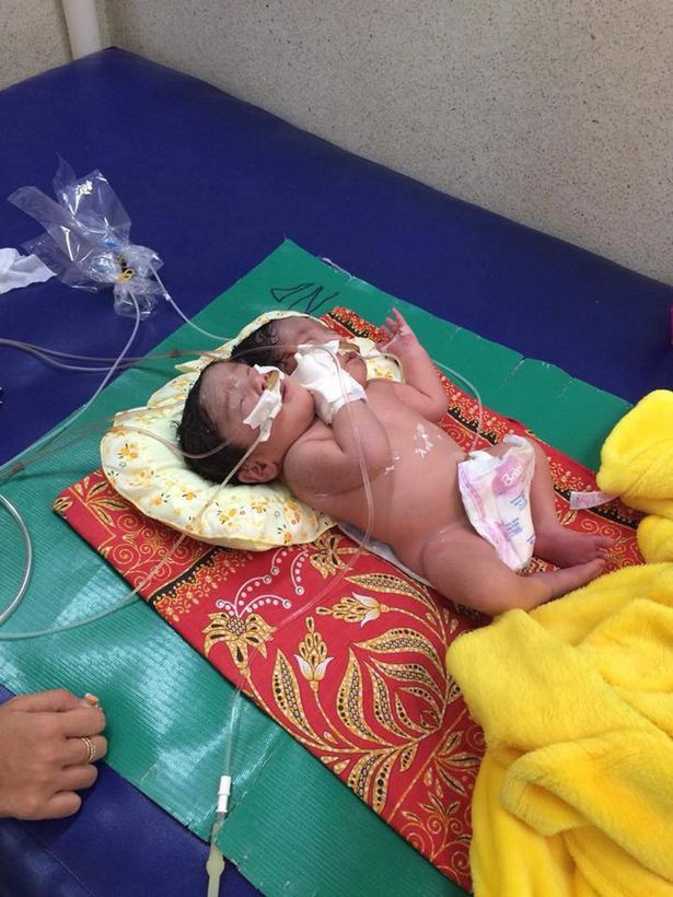 Campuchia: Em bé chào đời có 2 đầu, nặng 6,8kg