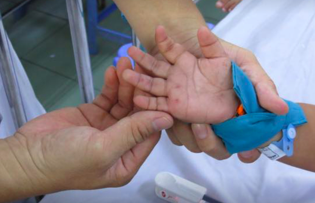 Bệnh tay chân miệng: Làm gì để trẻ không bị biến chứng nguy hiểm?