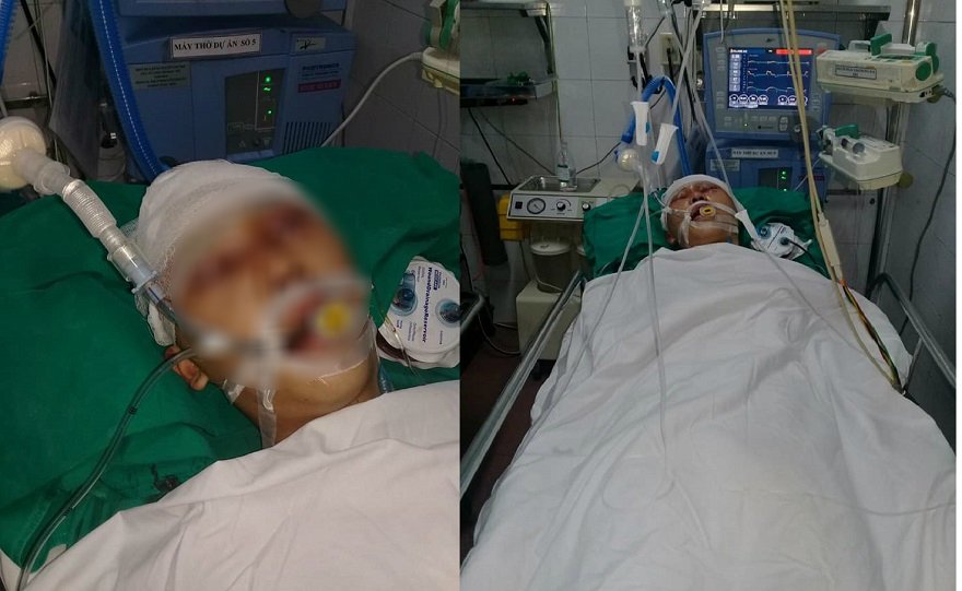 Hà Nội: Nam học sinh bị đánh chấn thương sọ não ở gần nhà