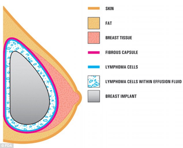 Cảnh báo: Nâng ngực làm tăng tỷ lệ ung thư vú