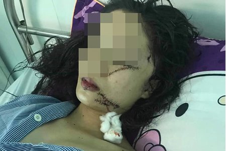 Thiếu nữ bị ba bạn gái vây đánh, rạch mặt trong đêm khâu 60 mũi