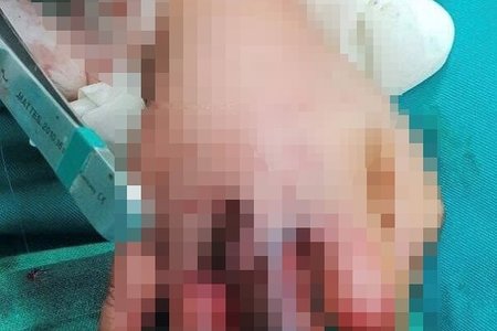 Nghệ An: Bé trai 4 tuổi dập nát bàn tay vì nghịch máy ép mía