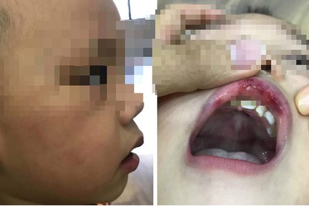 Thông tin mới vụ cô giáo tát trẻ 3 tuổi bầm tím mặt, tụ máu môi