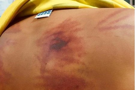 Bình Thuận: Bé trai bị đánh dã man trong khóa tu nhập viện