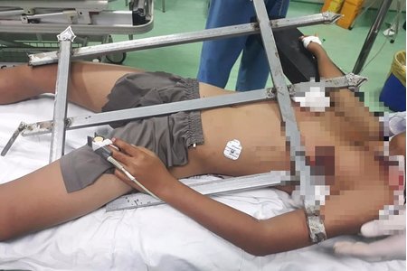 Bé trai 13 tuổi ở Nghệ An bị mũi sắt nhọn hàng rào đâm xuyên ngực