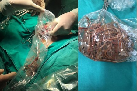 Phú Thọ: Phát hiện 100 con giun ngoe nguẩy trong bụng bé 11 tuổi