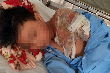 Thanh Hóa: Bé trai 11 tuổi bị cha tạt nước sôi