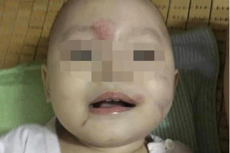 Thông tin chính thức vụ bé gái 14 tháng tuổi bị bầm tím vùng mặt ở Hải Phòng