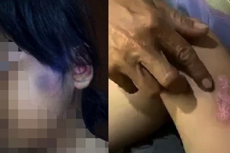 Bé gái 6 tuổi bị cha dượng châm tàn thuốc, bạo hành cơ thể