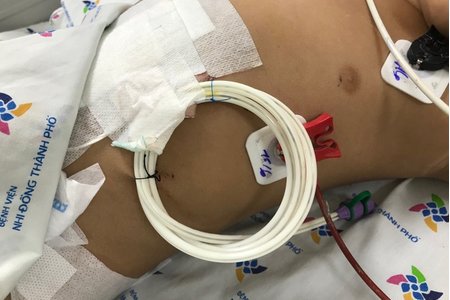 Bé trai 2,5 tuổi nhập viện cấp cứu sau khi uống nhầm hóa chất trong chai nước