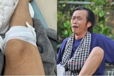 Hoài Linh bị vật nuôi 'phản chủ' đá đến bị thương băng bó ở chân