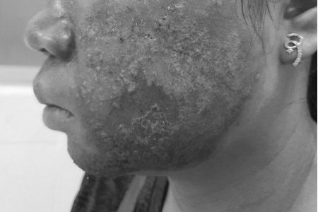Người phụ nữ bị nhiễm trùng, mưng mủ da mặt sau khi lăn kim tại spa