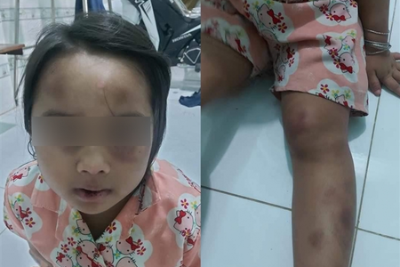 Bình Dương: Tạm giữ vợ chồng cô ruột bạo hành cháu gái 6 tuổi