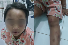 Bình Dương: Tạm giữ vợ chồng cô ruột bạo hành cháu gái 6 tuổi