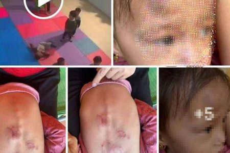 Đình chỉ cơ sở mầm non xảy ra vụ bé gái 2 tuổi bị bạn đánh, cắn bầm tím người