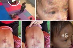 Đình chỉ cơ sở mầm non xảy ra vụ bé gái 2 tuổi bị bạn đánh, cắn bầm tím người