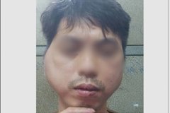 Thanh niên tố bị chủ quán lẩu nướng ở Hà Nội đánh biến dạng khuôn mặt
