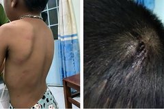 Bắt tạm giam người cha nhiều lần đánh đập, hành hạ con trai 6 tuổi
