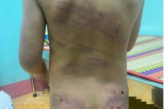 Bình Phước: Xác minh vụ bé gái nghi bị bạo hành với nhiều vết bầm tím trên người