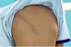 Khởi tố vụ mẹ kế đánh con chồng với hơn 20 vết bầm trên cơ thể