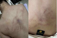 Điều tra vụ bé gái 4 tuổi bị giáo viên mầm non đánh đập, kéo lê, ném vào tường ở Hà Nội