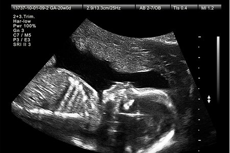 Luật Dân số: Bác sĩ tiết lộ giới tính thai nhi sẽ bị đình chỉ hành nghề