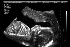 Luật Dân số: Bác sĩ tiết lộ giới tính thai nhi sẽ bị đình chỉ hành nghề