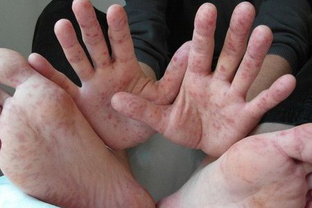 6 ca tử vong vì bệnh tay chân miệng:Chủng virus EV71 nguy hiểm thế nào