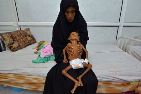 Nạn đói ở Yemen có thể trở thành thảm họa kinh hoàng nhất lịch sử