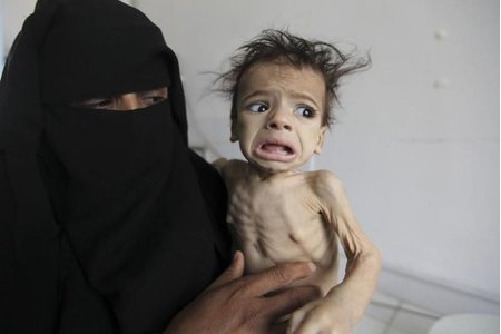 Nạn đói kinh hoàng tại Yemen: Ám ảnh những em bé 'da bọc xương'