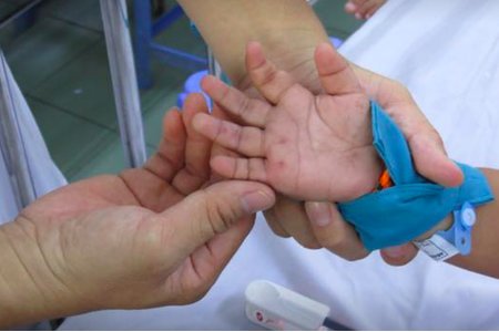 Bệnh tay chân miệng: Làm gì để trẻ không bị biến chứng nguy hiểm?