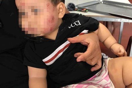 Mẹ trẻ tố con trai 11 tháng tuổi bị cắn khắp mặt sau khi đi nhà trẻ về