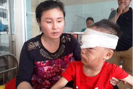 Kinh hoàng bé trai 6 tuổi ở Thanh Hóa bị chó nhà cắn rách mặt