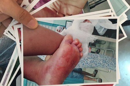 Bảo mẫu 'chui' gạt nhầm vòi nước nóng làm bé gái 18 tháng bị bỏng