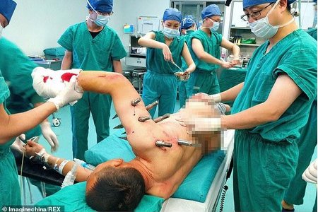 Công nhân Trung Quốc bị 10 cọc thép đâm xuyên người sau tai nạn