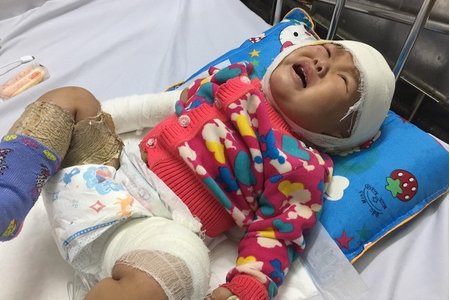 Bé gái 10 tháng tuổi ngã vào bếp lửa bị bỏng nặng