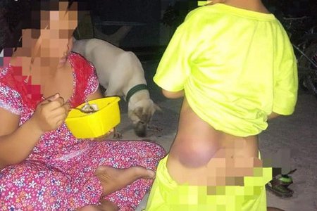 Bé trai khuyết tật 7 tuổi bị cô giáo đánh bầm tím người ở Long An 