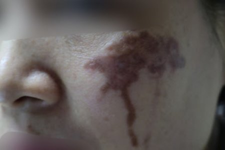 Chấm axit chữa nám da ở spa, người phụ nữ bị loang lổ mặt, sạm đen