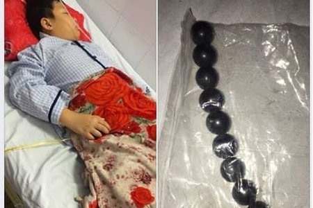 Bé trai 10 tuổi bị cắt 40cm ruột non sau khi nuốt 9 viên bi sắt