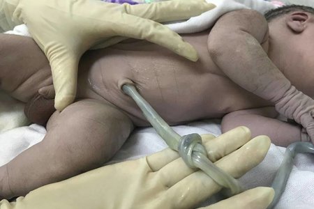 Hà Nội: Sản phụ bị suy thai do dây rốn thắt nút điều trị thành công