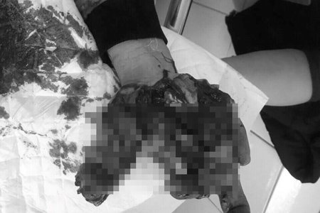 Nam Định: Nam thanh niên dập nát bàn tay vì nghịch thuốc pháo