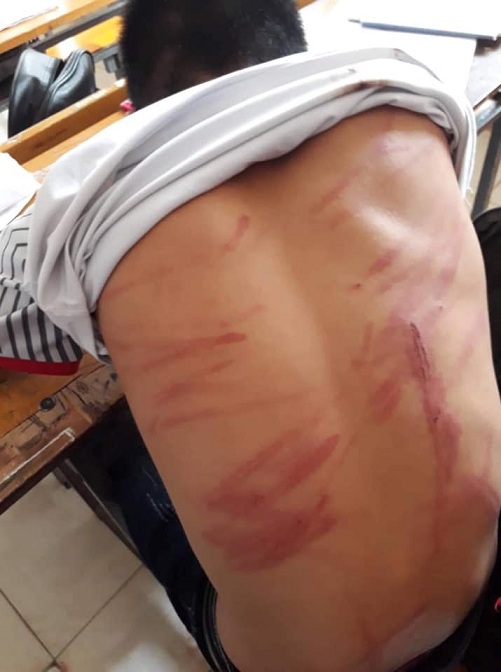 Nghi vấn một học sinh lớp 8 bị bố đánh nhập viện tại Hà Tĩnh