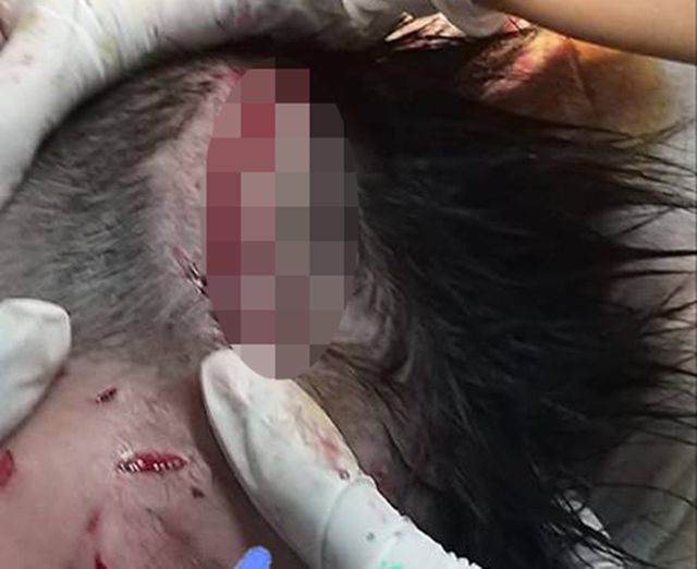 Bé trai 4 tuổi ở Hà Tĩnh bị chó béc giê nhà lao vào cắn xé lóc 13cm da đầu
