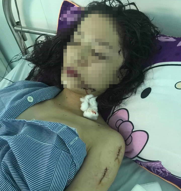 Nguyên nhân khiến thiếu nữ 18 tuổi bị rạch mặt dã man ở Bắc Ninh